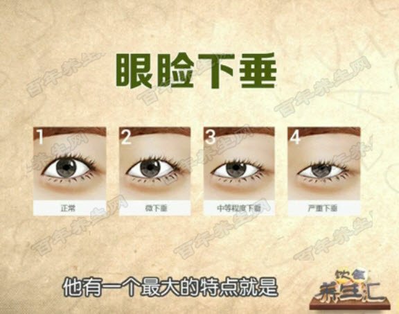 重症肌无力的表现
