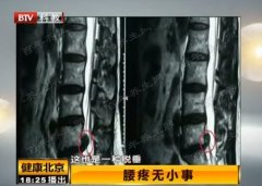 20160706健康北京视频和笔记:张挺杰,腰椎间盘突出,腰椎间盘脱垂