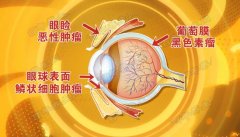 20160817养生堂视频和笔记:王艳玲,眼部恶性肿瘤,失明,黄斑变性