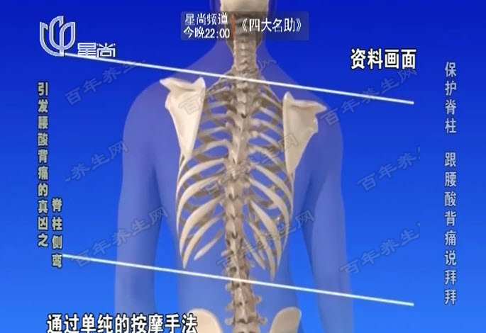 脊柱弯曲