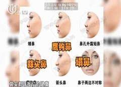 20161212X诊所视频和笔记:余安胜,鼻诊,鼻中隔偏曲,塞鼻疗法