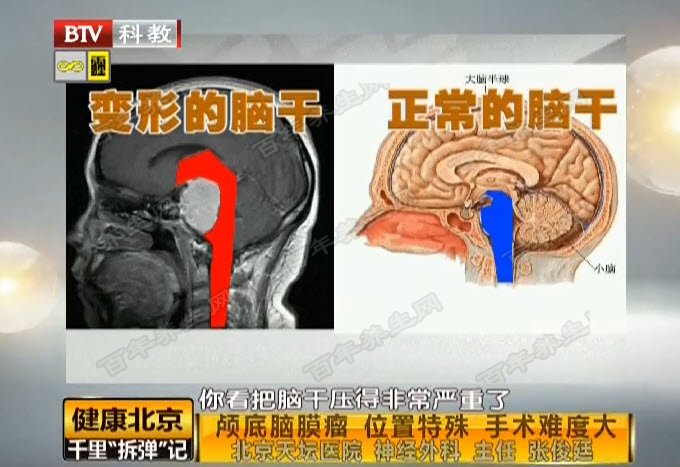 脑膜瘤的位置