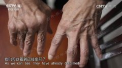 20170115中华医药视频和笔记:张本刚,类风湿关节炎,酒姜鸡