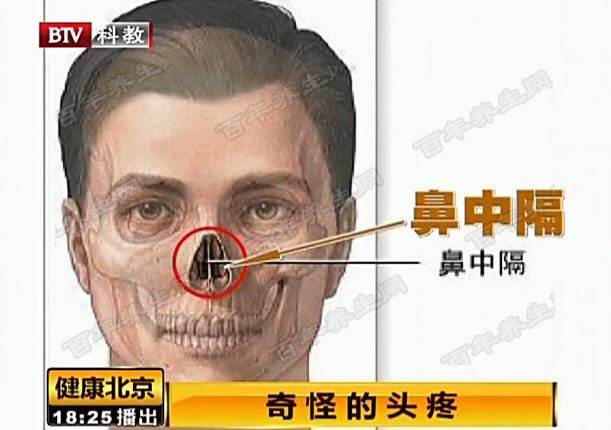 鼻中隔偏曲怎么办