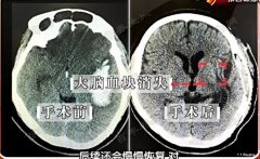 20170330我是大医生视频和笔记:陈海波,张晔,DHA,脑梗塞,脑缺血