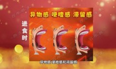 20170420养生堂视频和笔记:应建明,刘金英,食管癌,胃食管反流