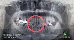20170611中华医药视频和笔记:张海钟,牙齿缺失,叩齿,义齿,刷牙