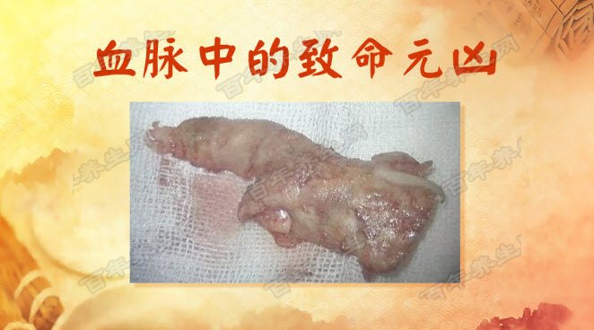 致命的痰核