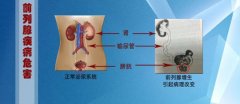 20171229医生开讲视频和笔记:吴志平,前列腺炎,前列腺,尿毒症