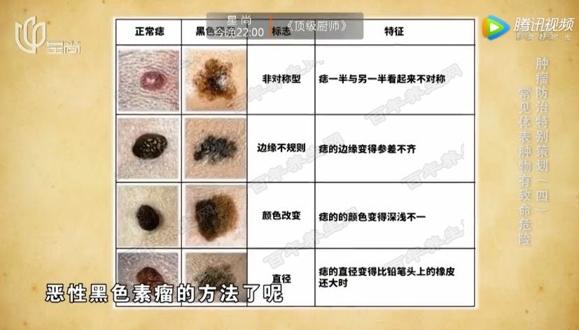 20180607X诊所视频和笔记:刘天一,黑色素瘤,痣,基底细胞癌,汗管瘤