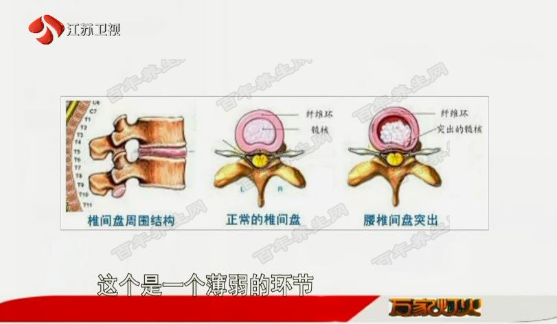 20180713万家灯火视频和笔记:康然,腰椎间盘突出