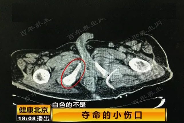 压疮