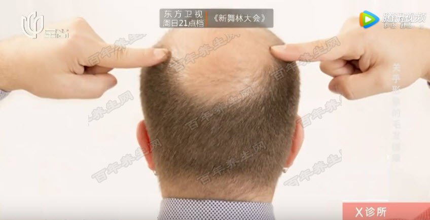脱发