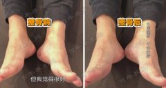 20190725X诊所视频和笔记:詹红生,中医整骨,长短腿,扭伤