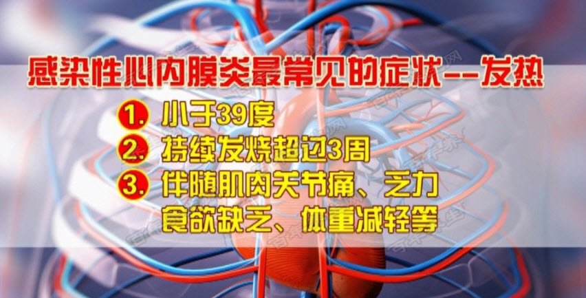 感染性心内膜炎
