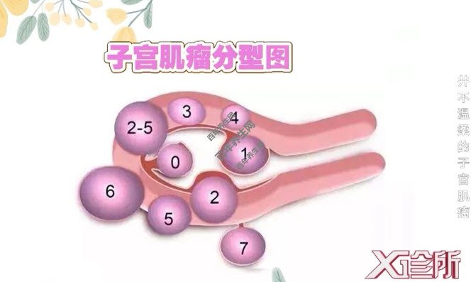 子宫肌瘤的分类