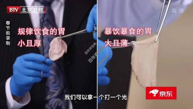 袖状胃切除术