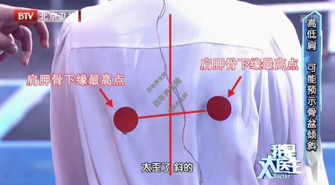 高低肩可能预示骨盆倾斜