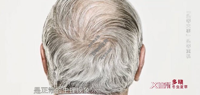 20210125临床视频及笔记:郑志忠 白发 白癜风 毛囊炎 脂溢性皮炎