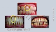 20210428X诊所视频和笔记:魏兵,龋齿,牙周病,牙龈炎,种植牙