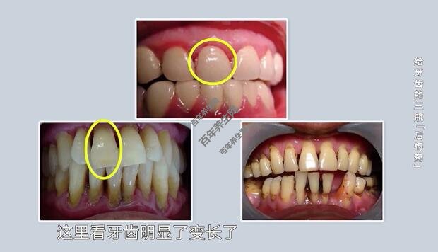 牙周病