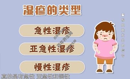 湿疹的类型