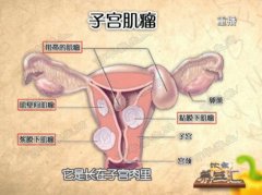 子宫肌瘤图片