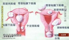 子宫肌瘤的生长位置图片