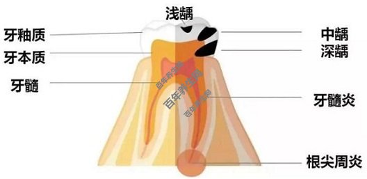 龋病的发展过程