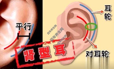 肾型耳