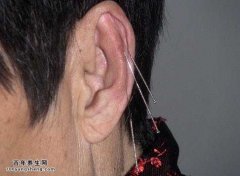 耳针疗法处方选穴原则和操作方法图片