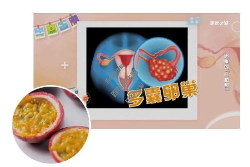 多囊卵巢