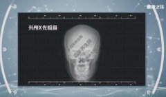 20220818健康之路视频和笔记:高健,洪楠,头颅CT检查,核磁共振