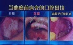 20220920养生堂视频和笔记:蔡志刚,刘宏伟,口腔溃疡,口腔癌