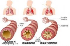 支气管哮喘的诊断标准图片