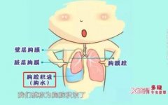 20230403X诊所视频和笔记:孙锟,王磊,陈笋,胎儿胸腔积液