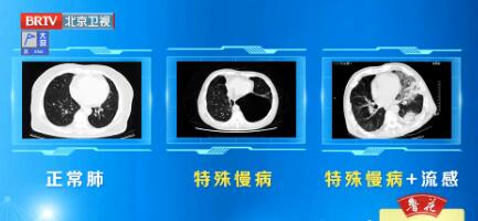 影像学下正常肺与特殊慢病情况下的肺，以及特殊慢病＋流感情况下肺的对比