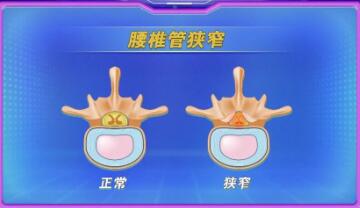 腰椎管狭窄