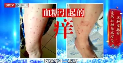血糖引起的痒
