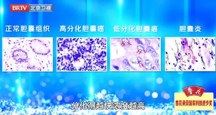 从胆汁性状来判断疾病的发展进程