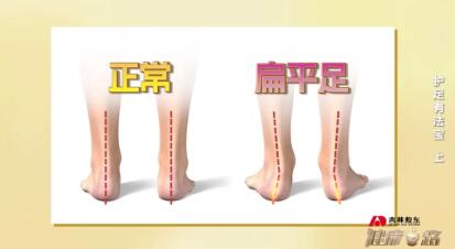 扁平足体态