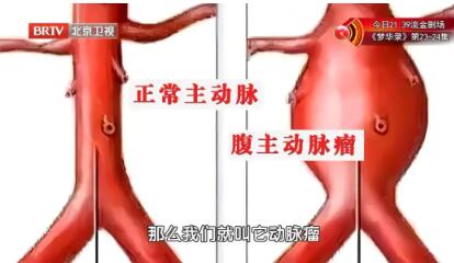 正常主动脉VS腹主动脉瘤