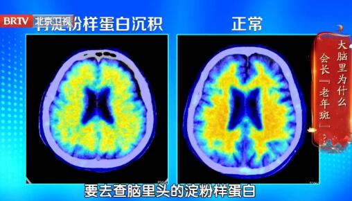 淀粉样蛋白沉积