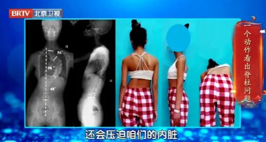 脊柱问题