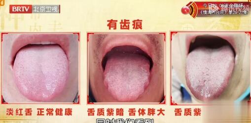 齿痕