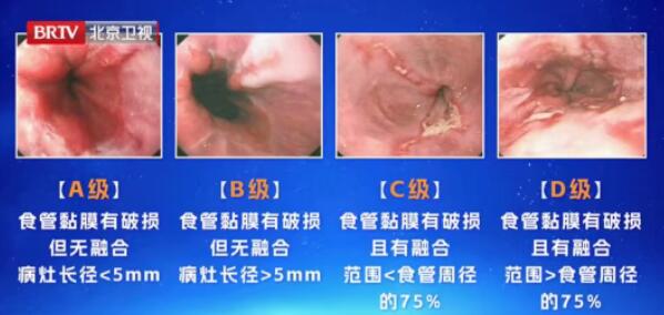 胃食管反流的分级