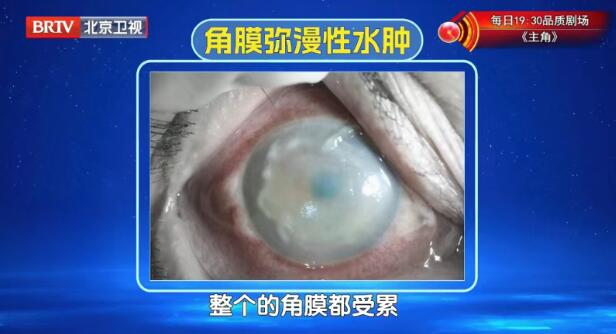 角膜弥漫性水肿